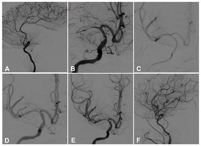 Endovascular Management of Intracranial Atherosclerosis-Related Large Vessel Occlusion With the A Direct Aspiration First-Pass Thrombectomy Compared With Solumbra Technique